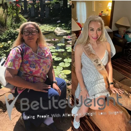 Weight Loss Surgery Gastric Sleeve before and after